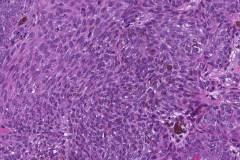 Pigmented basal cell carcinoma of the skin