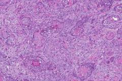 Sclerosing basal cell carcinoma of the skin