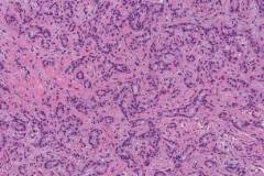 Bile duct adenoma of the liver