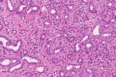 Bile duct adenoma of the liver