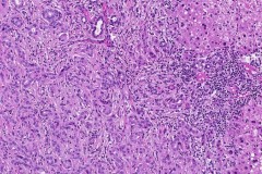 Bile duct adenoma of the liver