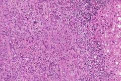 Bile duct adenoma of the liver