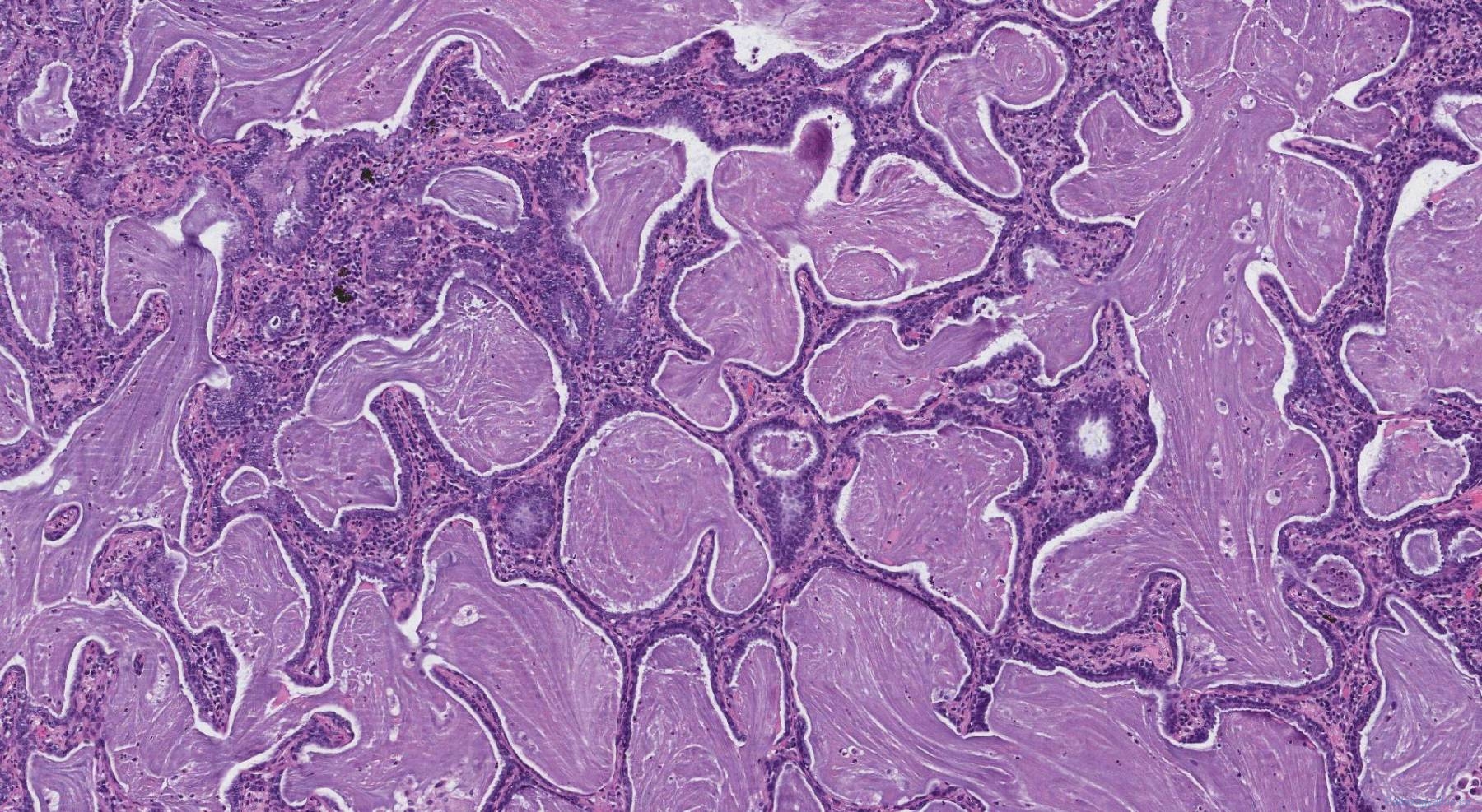 Bronchiolar Adenoma Archives Atlas Of Pathology