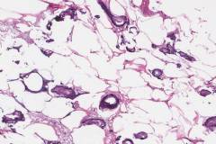 Calciphylaxis in subcutaneous adipose tissue