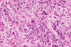 Carcinosarcoma of the uterus