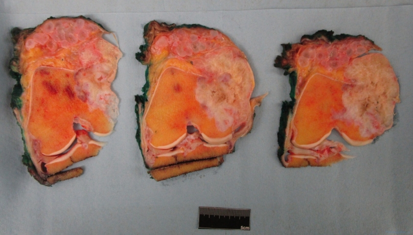 Chondrosarcoma of the distal femur