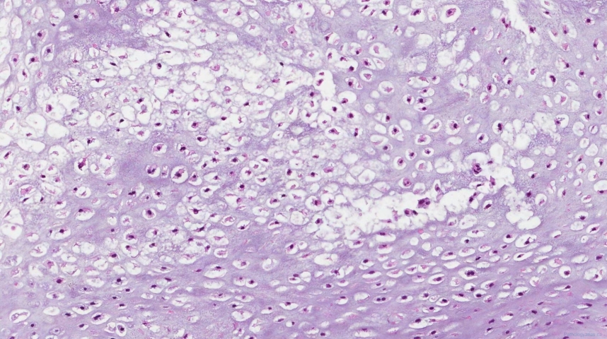 Central chondrosarcoma