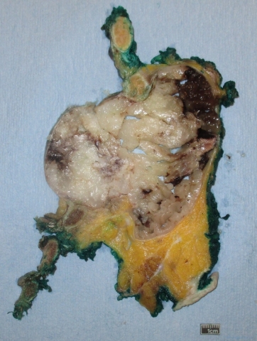 Chondrosarcoma arising in a rib with extension into soft tissue of the chest wall