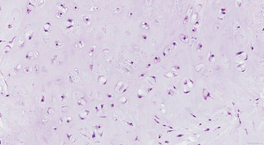Central chondrosarcoma