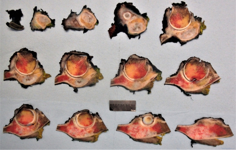 Chondrosarcoma