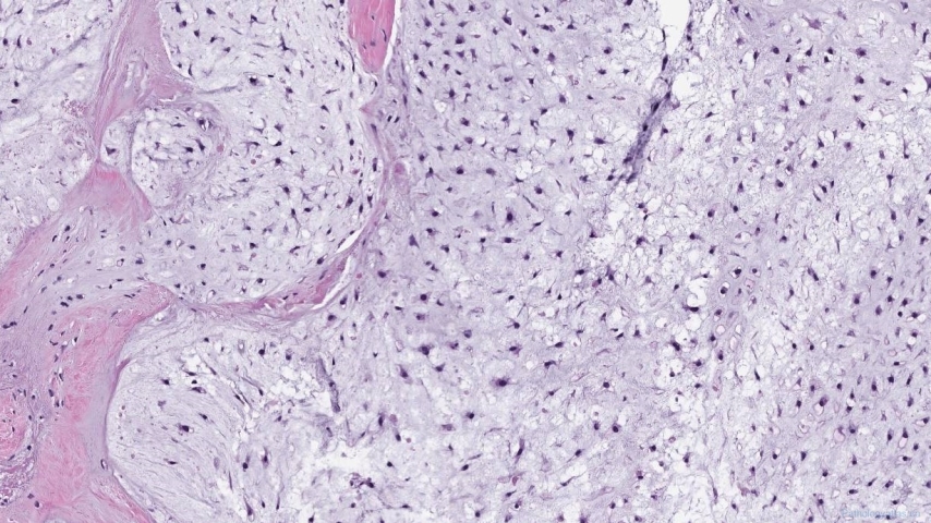 Central chondrosarcoma