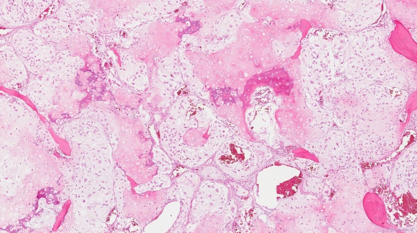 Central chondrosarcoma