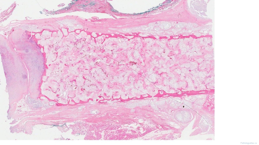Central chondrosarcoma