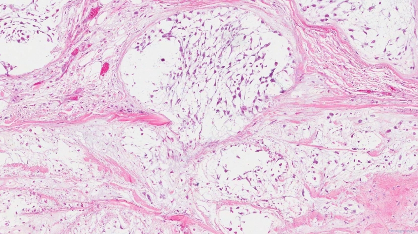 Central chondrosarcoma