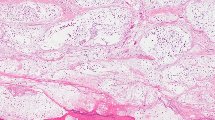 Central chondrosarcoma