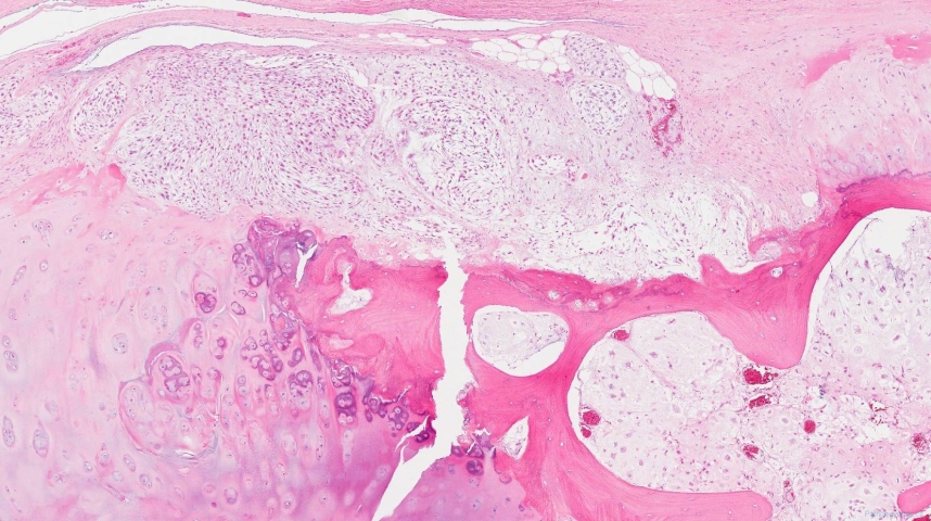 Central chondrosarcoma