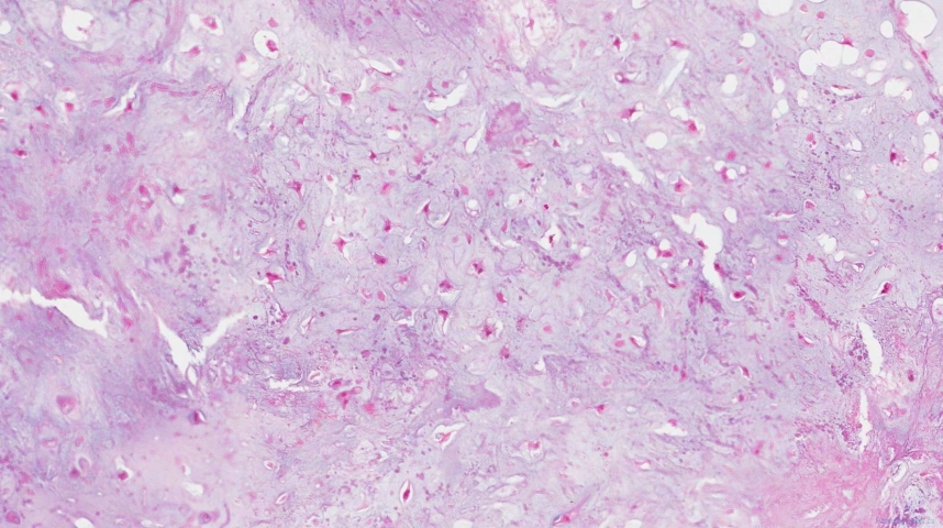Central chondrosarcoma