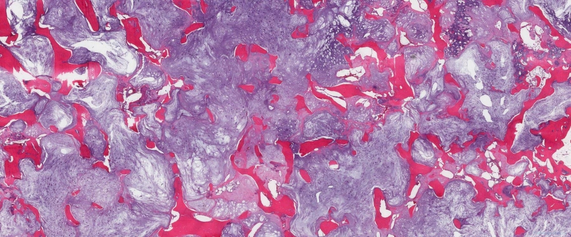 Grade 2 chondrosarcoma