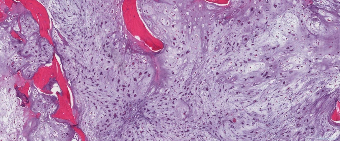 Grade 2 chondrosarcoma