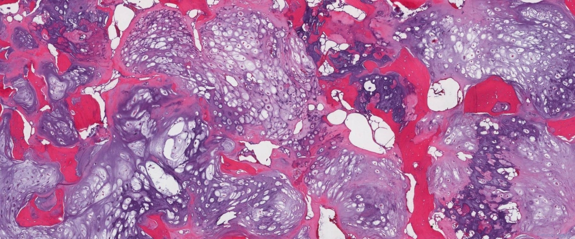 Grade 2 chondrosarcoma