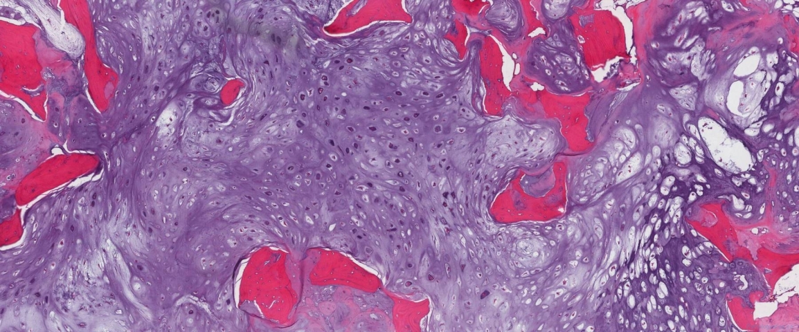 Grade 2 chondrosarcoma