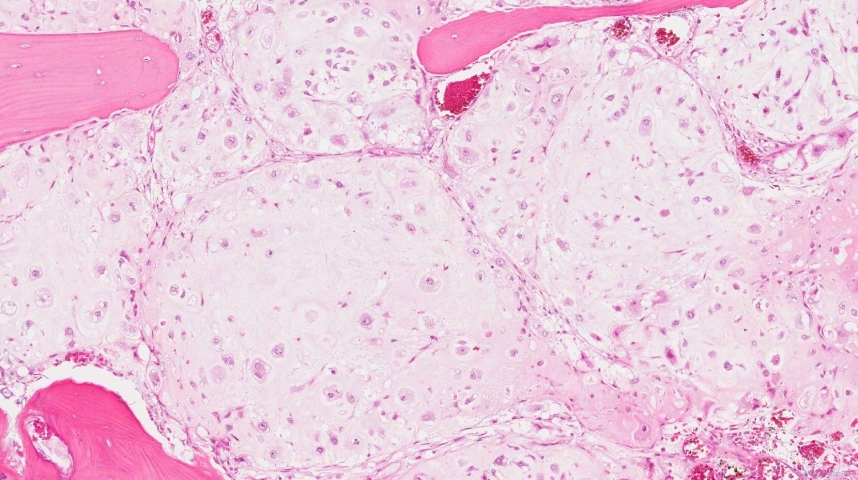 Central chondrosarcoma, grade 2