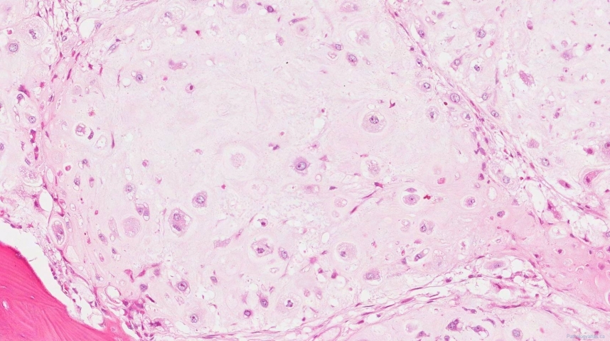 Central chondrosarcoma, grade 2