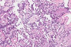 Ependymoma