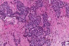 Ependymoma