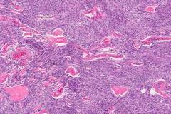 Angiomatous meningioma