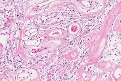 Angiomatous meningioma