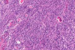 Angiomatous meningioma