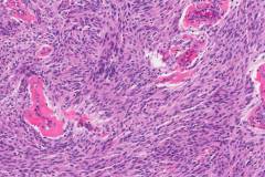 Angiomatous meningioma