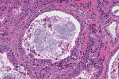 Ceruminous adenoma