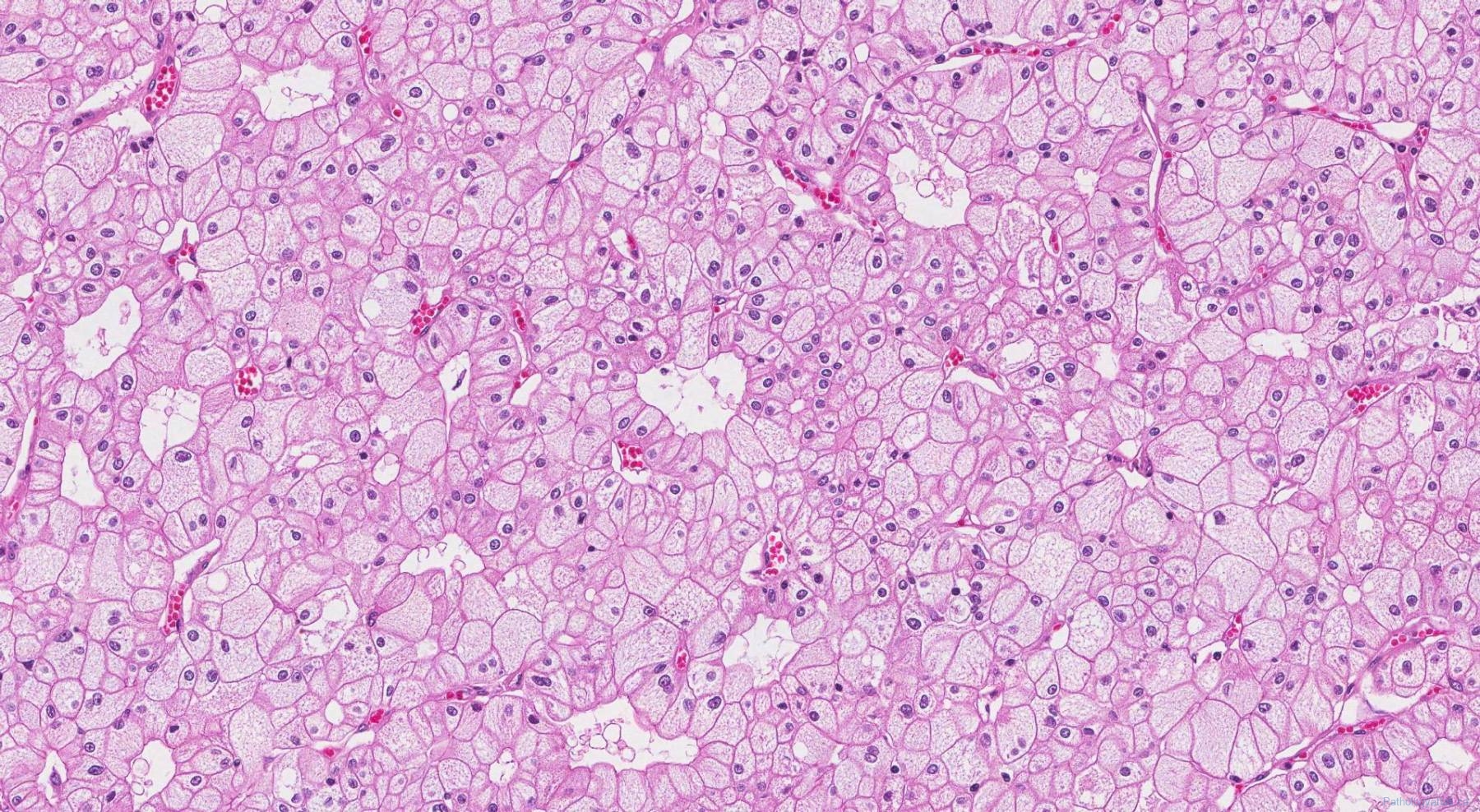 icd 10 code for chromophobe renal cell carcinoma
