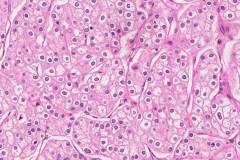 Chromophobe renal cell carcinoma