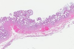 Chronic cholecystitis