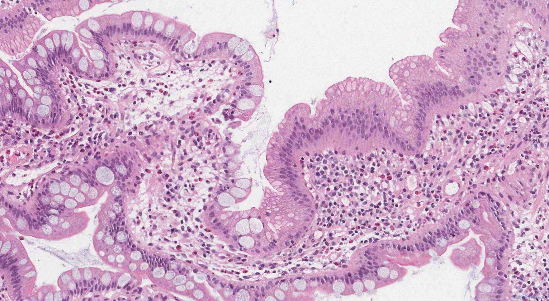 Chronic ileitis atlas of pathology