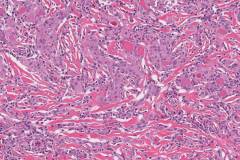 Chronic lymphocytic thyroiditis, fibrous type