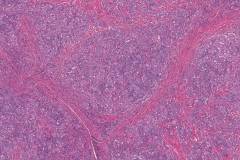Chronic lymphocytic thyroiditis, fibrous type