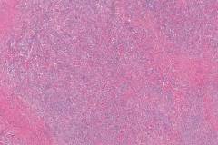 Chronic lymphocytic thyroiditis, fibrous type