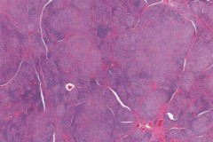 Chronic lymphocytic thyroiditis, fibrous type