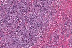 Chronic lymphocytic thyroiditis, fibrous type