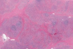 Chronic lymphocytic thyroiditis, fibrous type