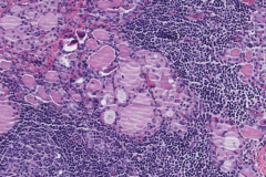 Chronic lymphocytic thyroiditis with oncocytic metaplasia