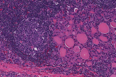 Severe chronic lymphocytic thyroiditis