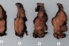 Chronic lymphocytic thyroiditis