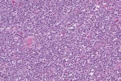 CIC translocation associated sarcoma