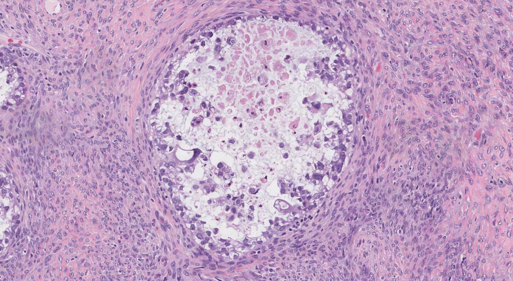 Clear Cell Carcinoma Of The Ovary Atlas Of Pathology