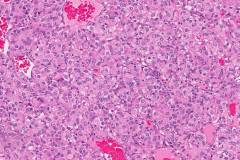 Clear cell renal cell carcinoma